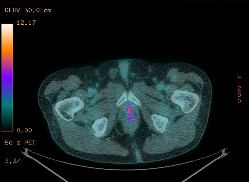 Appendiceal adenocarcinoma complicated by retroperitoneal abscess (Radiopaedia 58007-65041 Axial PET-CT 195).jpg