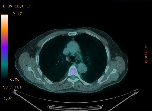 File:Appendiceal adenocarcinoma complicated by retroperitoneal abscess (Radiopaedia 58007-65041 Axial PET-CT 57).jpg