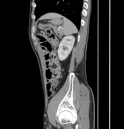 Appendiceal mucinous adenocarcinoma (Radiopaedia 66605-75922 C 54).jpg