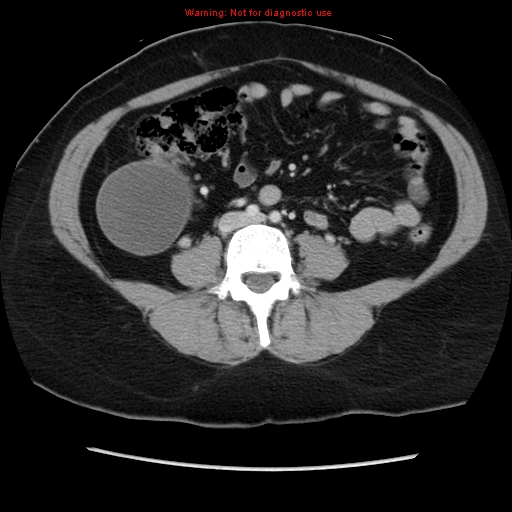 Appendiceal mucinous cystadenoma (Radiopaedia 8263-9111 Axial liver window 49).jpg