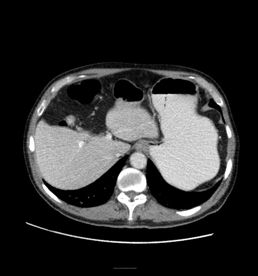 Appendicitis with localized perforation and abscess formation (Radiopaedia 49035-54130 A 22).jpg