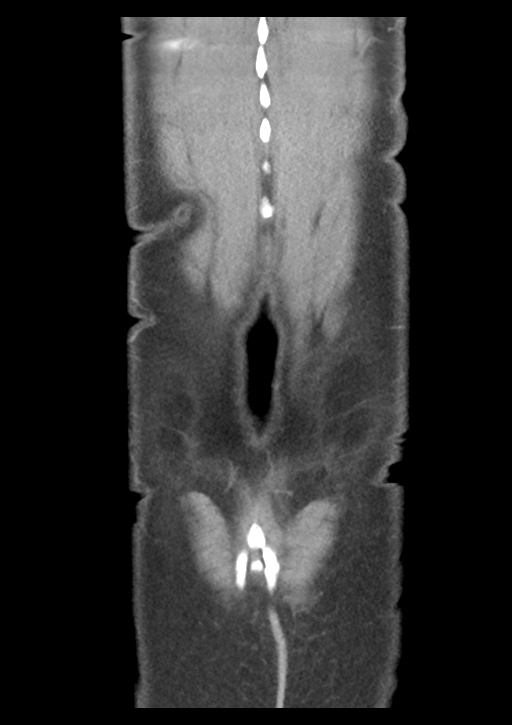 Appendicitis with thickening of the terminal ileum (Radiopaedia 42432-45550 B 55).png