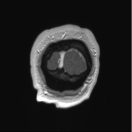 Arachnoid cyst with subdural hematoma (Radiopaedia 85892-101743 Coronal T1 C+ 2).png