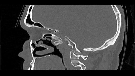 Arcuate foramen (Radiopaedia 89833-106944 Sagittal bone window 82).jpg