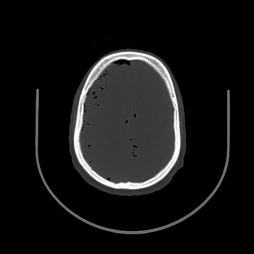 Arrow injury to the brain (Radiopaedia 72101-82607 Axial bone window 83).jpg