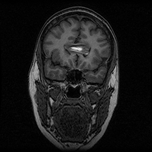 Arteriovenous malformation (cerebral) (Radiopaedia 40070-42580 Coronal T1 42).png
