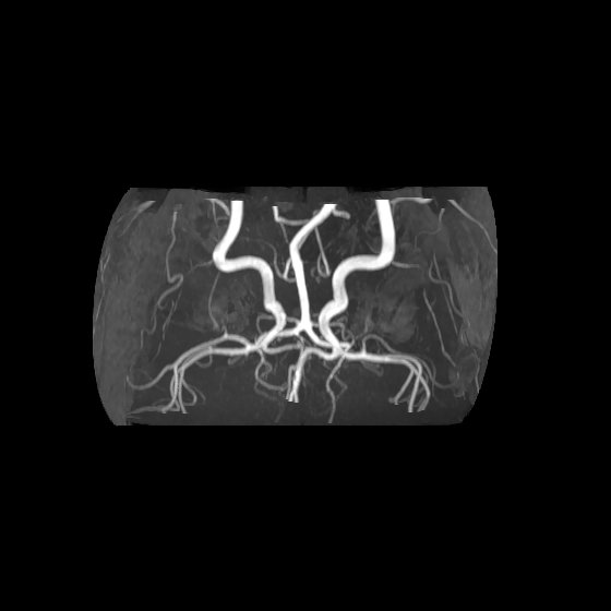 Artery of Percheron infarct (Radiopaedia 40966-43676 F 59).jpg