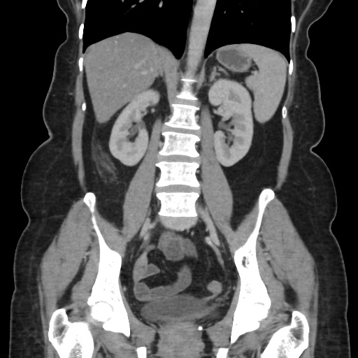 Ascending colon diverticulitis (Radiopaedia 61970-70040 B 39).jpg