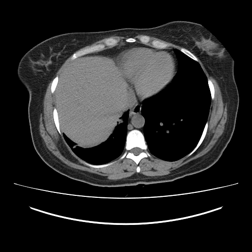 Ascending retrocecal appendicitis with liver abscesses (Radiopaedia 60066-67615 Axial non-contrast 7).jpg