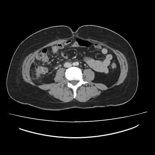 File:Ascending retrocecal appendicitis with liver abscesses (Radiopaedia 60066-67615 B 53).jpg