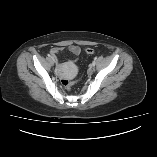 File:Ascending retrocecal appendicitis with liver abscesses (Radiopaedia 60066-67615 B 75).jpg