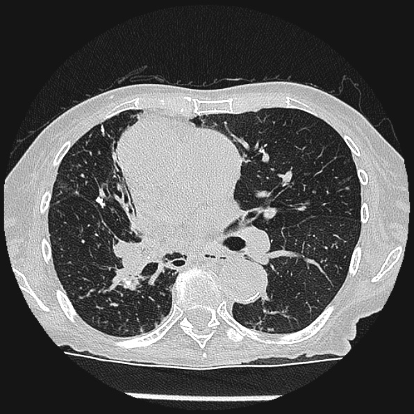 Aspergilloma (Radiopaedia 24458-24763 Axial lung window 33).jpg