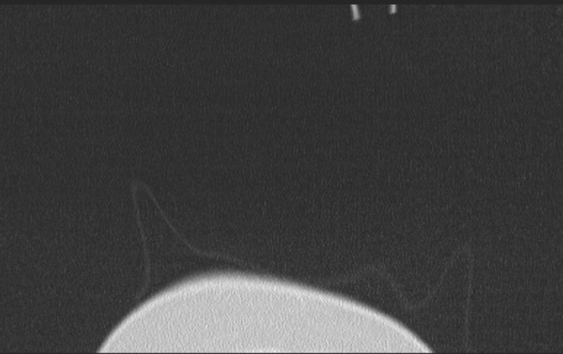 Aspirated tooth (Radiopaedia 28584-28844 Axial lung window 7).jpg
