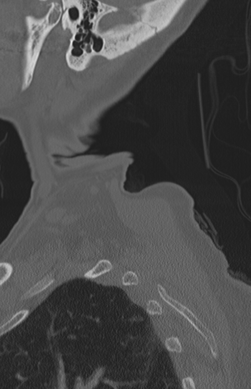 Atlanto-axial subluxation (Radiopaedia 36610-38176 Sagittal bone window 6).png