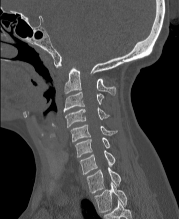 Atlanto-occipital assimilation with basilar invagination (Radiopaedia 70122-80188 Sagittal bone window 45).jpg
