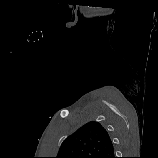 Atlanto-occipital dissociation (Traynelis type 1), C2 teardrop fracture, C6-7 facet joint dislocation (Radiopaedia 87655-104061 Sagittal bone window 73).jpg