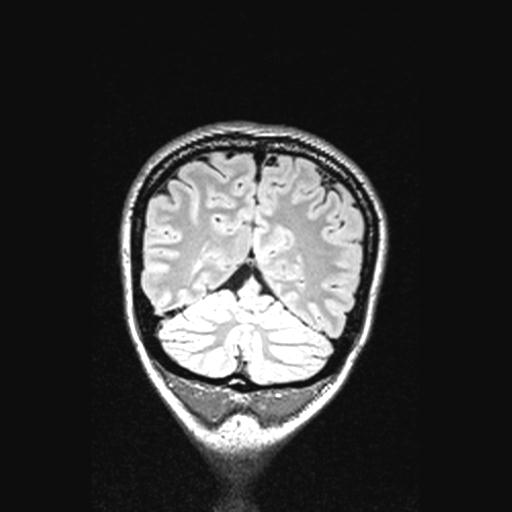 Atretic encephalocoele with inferior vermis hypoplasia (Radiopaedia 30443-31108 Coronal FLAIR 43).jpg