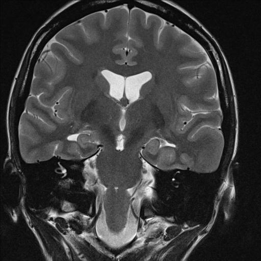 File:Atretic encephalocoele with inferior vermis hypoplasia (Radiopaedia 30443-31108 Coronal T2 7).jpg