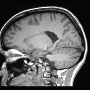 Atretic encephalocoele with inferior vermis hypoplasia (Radiopaedia 30443-31108 Sagittal T1 82).jpg