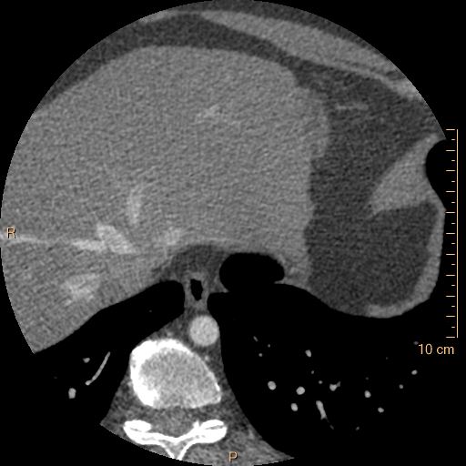 Atrial septal defect (upper sinus venosus type) with partial anomalous pulmonary venous return into superior vena cava (Radiopaedia 73228-83961 A 265).jpg