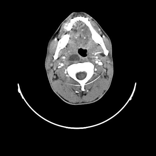 File:Atypical 2nd branchial cleft cyst (type IV) - infected (Radiopaedia 20986-20924 A 9).jpg