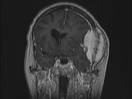 Atypical meningioma (Radiopaedia 62985-71406 Coronal T1 C+ 44).jpg