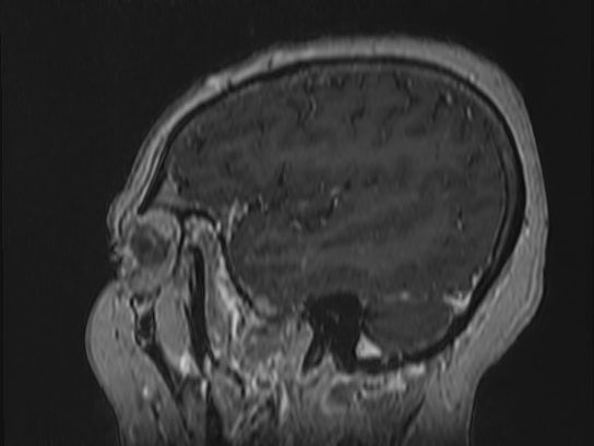 Atypical meningioma (Radiopaedia 62985-71406 Sagittal T1 C+ 13).jpg
