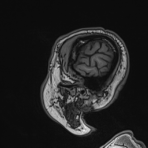 File:Atypical meningioma (WHO grade II) with brain invasion (Radiopaedia 57767-64729 Sagittal T1 14).png