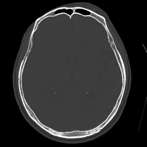 Atypical meningioma with skull invasion (Radiopaedia 34357-35649 Axial bone window 43).png