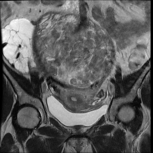 File:Atypical retroperitoneal lymphocoeles with large leiomyoma of uterus (Radiopaedia 32084-33027 Coronal T2 17).jpg