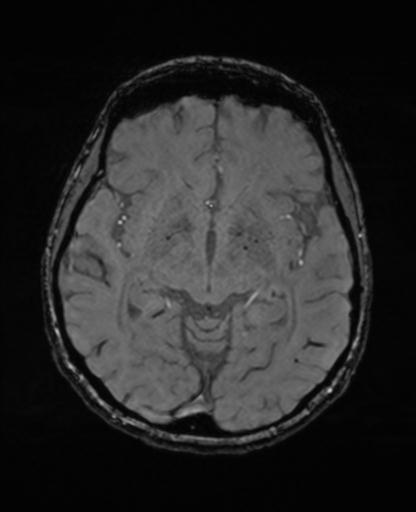 Autoimmune limbic encephalitis (Radiopaedia 30363-31005 SWI - magnitude 35).jpg