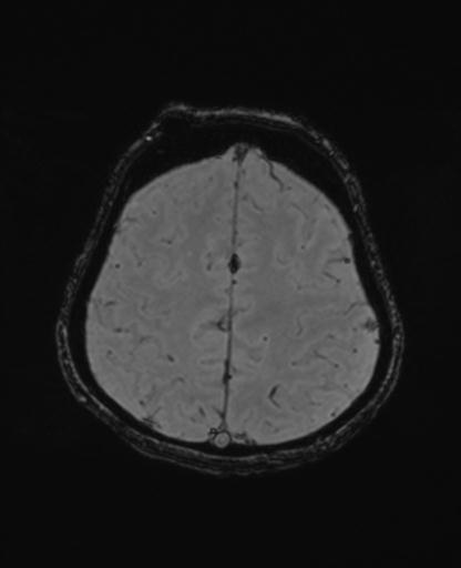 Autoimmune limbic encephalitis (Radiopaedia 30363-31005 SWI - magnitude 63).jpg