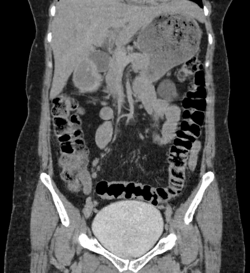Autosomal dominant polycystic kidney disease (Radiopaedia 38189-40194 Coronal C+ delayed 29).jpg