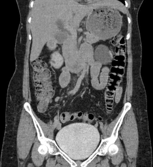 Autosomal dominant polycystic kidney disease (Radiopaedia 38189-40194 Coronal C+ delayed 34).jpg