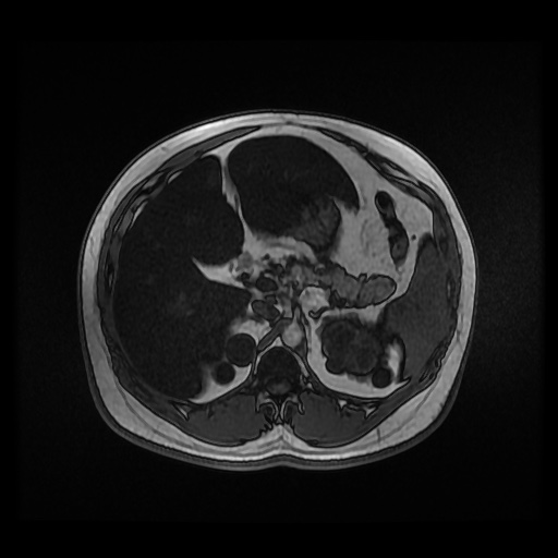 Autosomal dominant polycystic kidney disease (Radiopaedia 50259-55611 Axial 2D Dual Echo 33).jpg