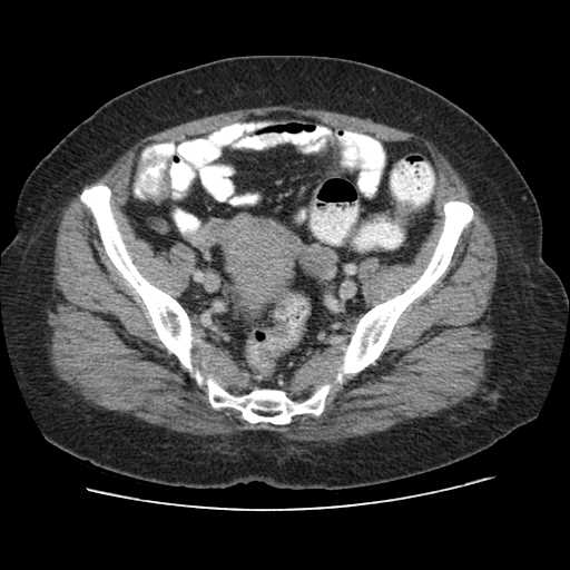 Autosomal dominant polycystic kidney disease with hepatic involvement (Radiopaedia 32693-33662 B 66).jpg