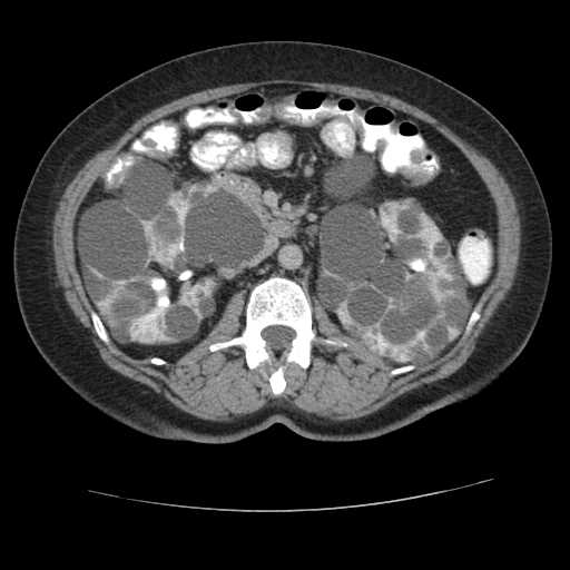 Autosomal dominant polycystic kidney disease with hepatic involvement (Radiopaedia 32693-33662 C 35).jpg
