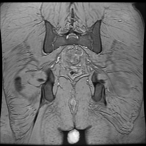 Avascular necrosis of the hip (Radiopaedia 61503-69465 F 87).jpg