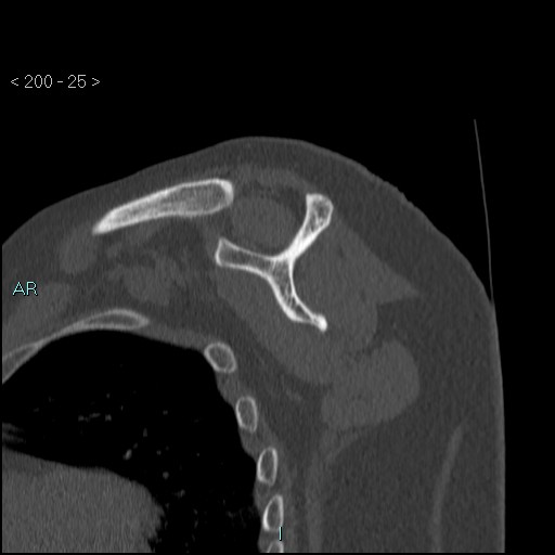 Avascular necrosis of the shoulder - Cruess stage I (Radiopaedia 77674-89887 Sagittal bone window 24).jpg