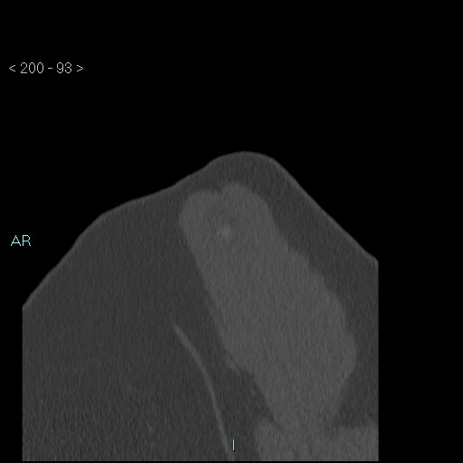 Avascular necrosis of the shoulder - Cruess stage I (Radiopaedia 77674-89887 Sagittal bone window 92).jpg