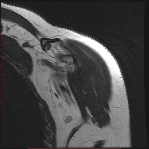 File:Avulsion fracture - greater tuberosity of humerus (Radiopaedia 25457-25703 Coronal T2 1).jpg
