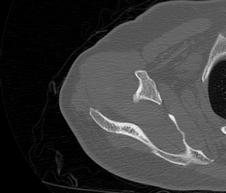 Avulsion fracture - greater tuberosity of humerus (Radiopaedia 71216-81514 Axial bone window 23).jpg