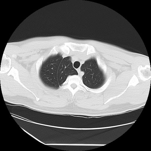 Azygos fissure (Radiopaedia 88181-104784 Axial lung window 6).jpg