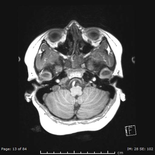 File:Balo concentric sclerosis (Radiopaedia 61637-69636 Axial T1 13).jpg