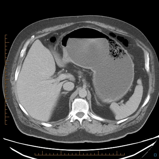 File:Bariatric balloon causing gastric outlet obstruction (Radiopaedia 54449-60672 A 12).jpg
