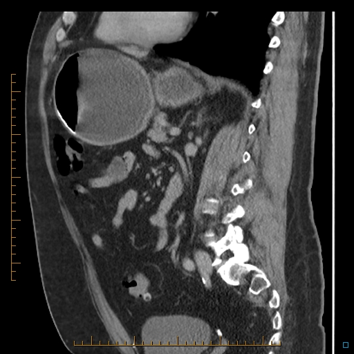 Bariatric balloon causing gastric outlet obstruction (Radiopaedia 54449-60672 C 35).jpg