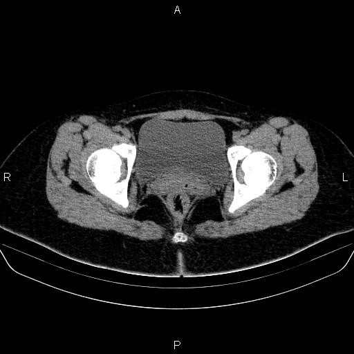 File:Bartholin gland cyst (Radiopaedia 62635-70930 Axial non-contrast 67).jpg
