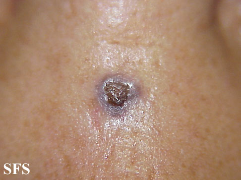 Basal Cell Carcinoma (Dermatology Atlas 64).jpg