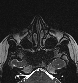 Basal cell carcinoma - nasal region (Radiopaedia 70292-80365 Axial Gradient Echo 43).jpg