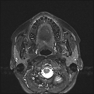 File:Basal cell carcinoma - nasal region (Radiopaedia 70292-80365 Axial STIR 19).jpg
